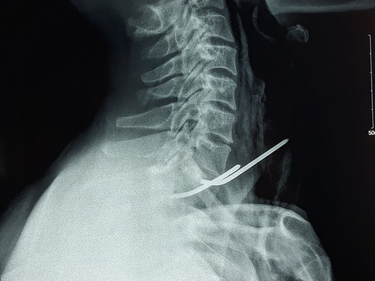 Cứu sống người đàn ông bị đinh đâm xuyên thực quản, khí quản