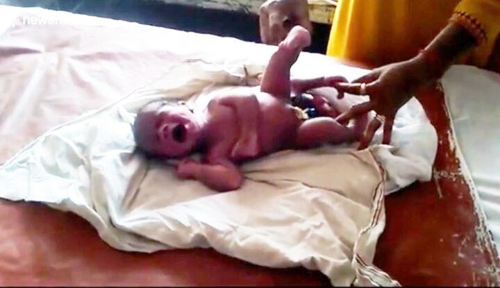 Kỳ lạ cậu bé 4 chân ở Ấn Độ ra đời được gọi là “phép màu Thượng đế”