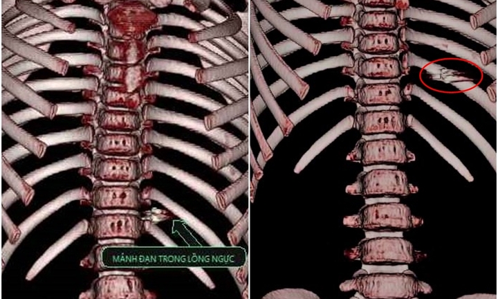 Mảnh đạn găm vào ngực bé gái 7 tuổi được lấy ra thế nào?