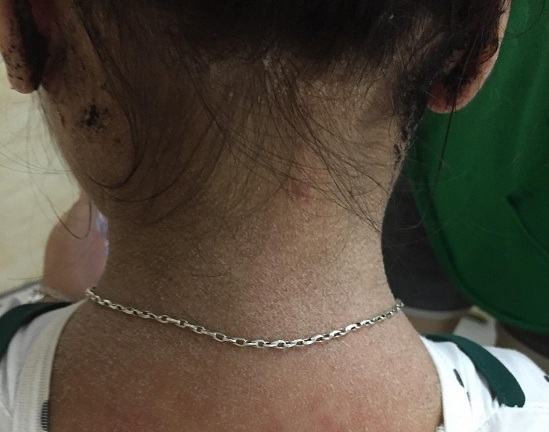 Thắt lòng bé gái 3 tuổi mắc chứng bệnh lạ có biểu hiện giống cảm cúm