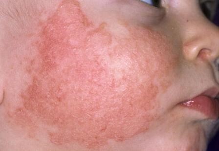 Cách chăm sóc khi trẻ sơ sinh bị nẻ