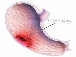 Vượt qua nỗi đau ung thư nhờ bài thuốc Nam gia truyền