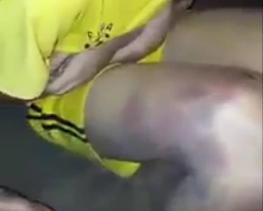 Thanh Hoá: Nam sinh lớp 9 bị bố đánh thâm tím người, bỏ nhà đi lang thang