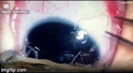 Kinh hãi cảnh bác sĩ gắp 11 con giun lúc nhúc trong mắt bé trai 5 tháng tuổi