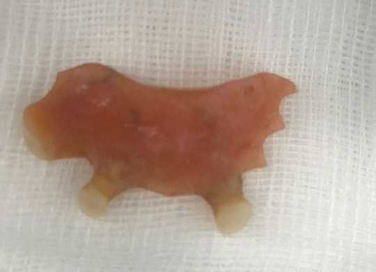 Cấp cứu bệnh nhân 40 tuổi vì răng giả rơi xuống thực quản