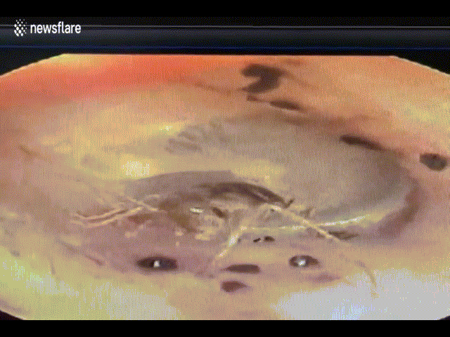 Video: Kinh hãi cảnh dế bò trong tai người ở Hải Dương