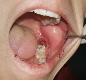 Nhổ răng khôn, máu chảy ồ ạt vì nguyên nhân không ngờ