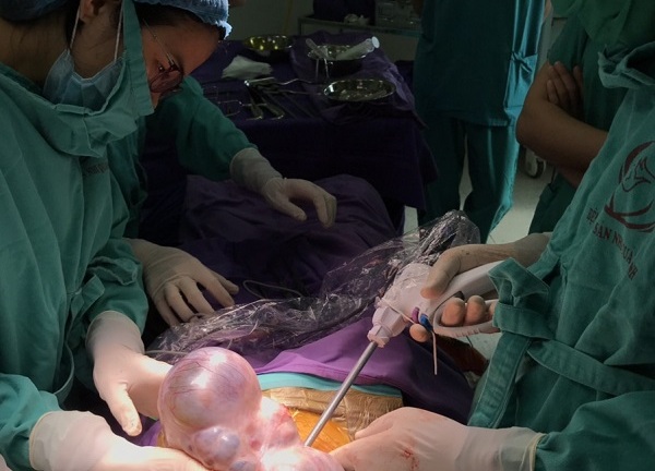 Khối u buồng trứng to như trái bóng: Đáng tiếc cho người phụ nữ không khám sức khỏe định kỳ