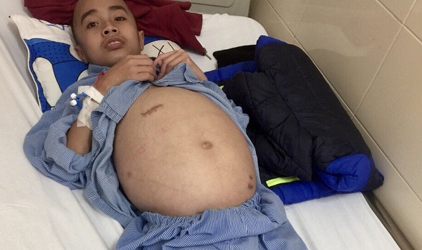 Mẹ khóc khô nước mắt khi u não con ngày càng to, không nhìn thấy gì