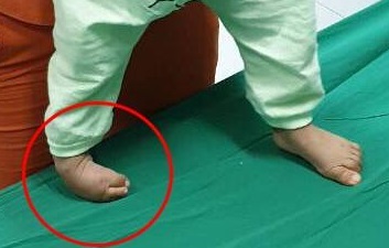 Bác sĩ  "uốn " chân cong thành thẳng cho bé 16 tháng tuổi