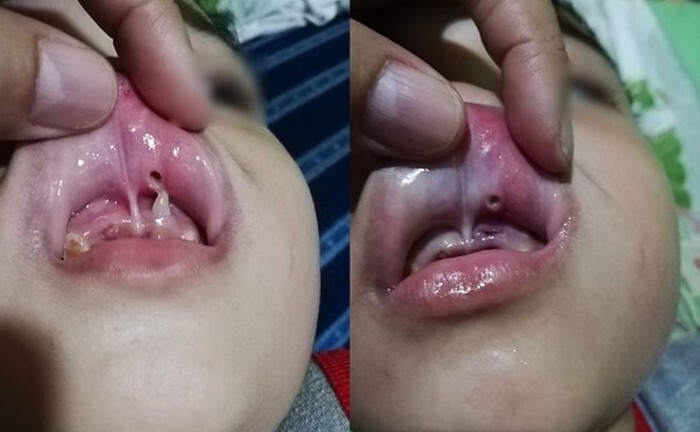 Tin tức đời sống mới nhất ngày 20/11/2018: Kinh hoàng chiếc răng mọc ngược đâm thủng môi