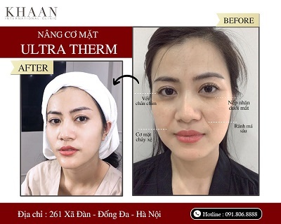 Ultra Therm – Công nghệ trẻ hóa làn da, kéo dài thanh xuân
