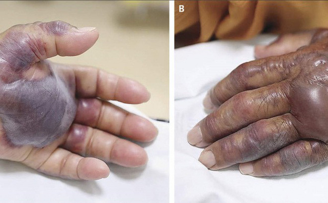 Hàn Quốc: Ăn hải sản sống, cụ ông 71 tuổi phải cắt cụt cả bàn tay do hoại tử