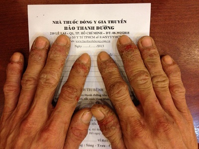 Chữa bệnh chàm á sừng bằng phương thuốc quý của Bảo Thanh Đường