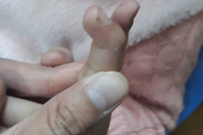 Hà Nội: Bé gái có ngón tay bị tật do mẹ tự chữa đứt tay ở nhà