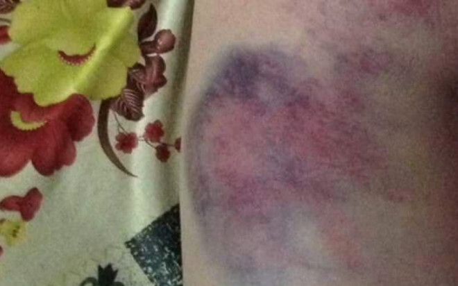 Xác minh vụ học sinh lớp 4 bị cô giáo chủ nhiệm đánh bầm mông ở Đắk Lắk