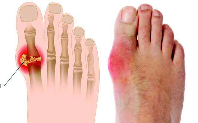 Acid uric cao bao nhiêu thì bị bệnh gout?