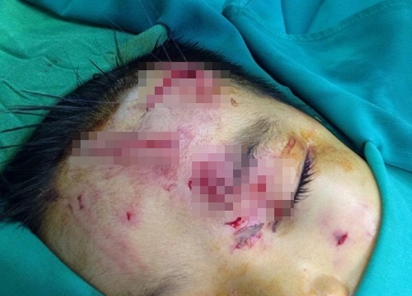 Bé trai 7 tuổi bị chó nhà cắn biến dạng khuôn mặt