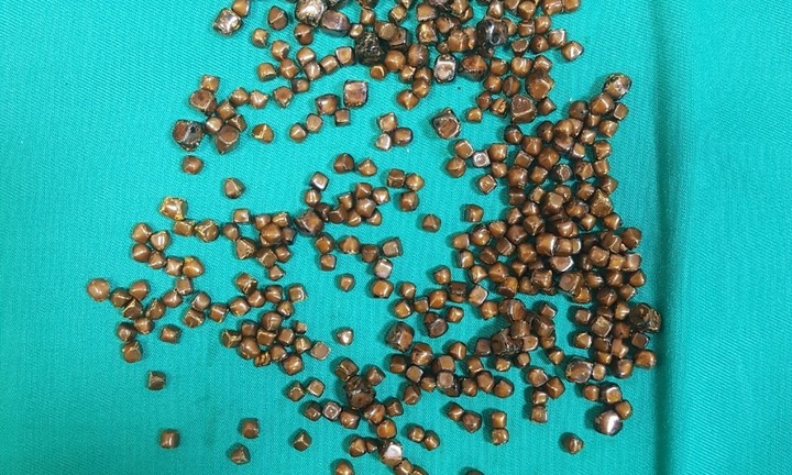 Bác sĩ giật mình thấy gần 400 viên sỏi trong mật bệnh nhân