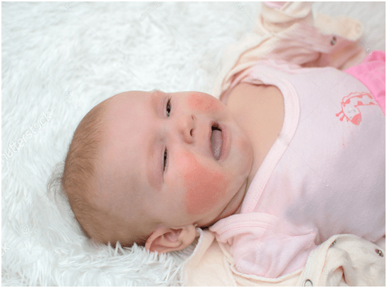 Gợi ý cách điều trị bệnh da khô ở trẻ