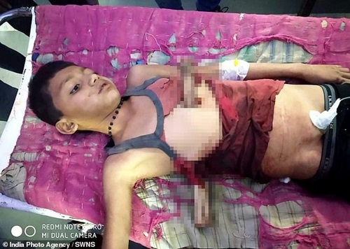 Cậu bé sống sót kỳ diệu sau khi bị cành cây đâm xuyên người vẫn cố gắng dắt em gái về nhà