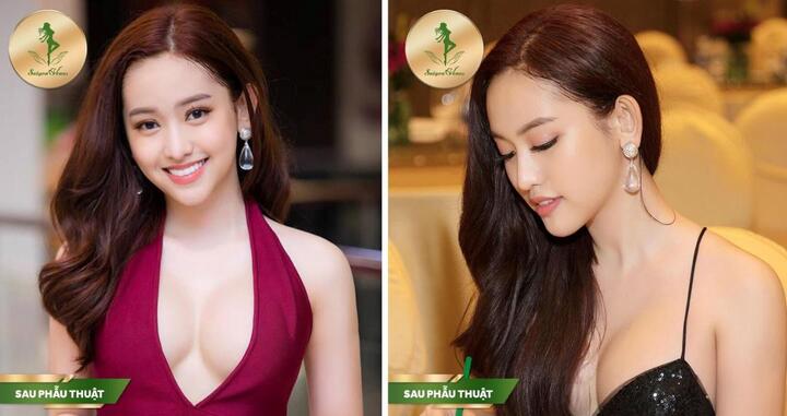 Đón đầu xu hướng làm đẹp 2019 tại Sài Gòn Venus - Nâng mũi Sform Plus