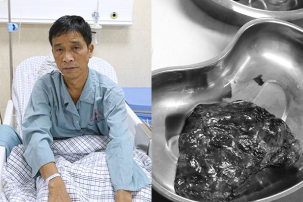 Bệnh nhân may mắn phát hiện bệnh ung thư phổi nhờ đi khám ho khan