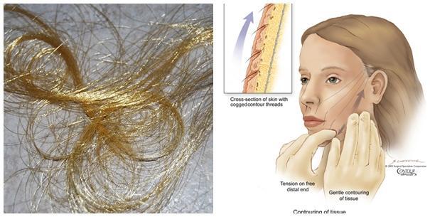 Đột phá công nghệ căng da mặt bằng chỉ vàng 24k
