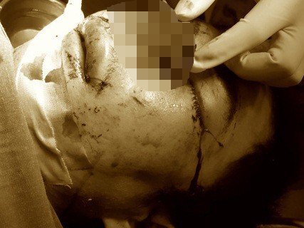 Tin tức đời sống mới nhất ngày 19/1/2019: Bình gas mini phát nổ khiến người đàn ông hỏng mắt, nát mũi