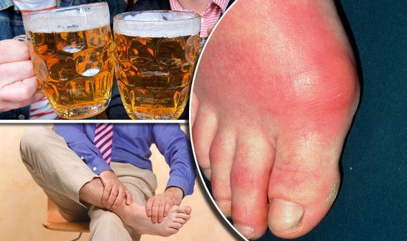 Bệnh gout cần kiêng ăn những gì? Người bệnh cần biết để chữa bệnh hiệu quả