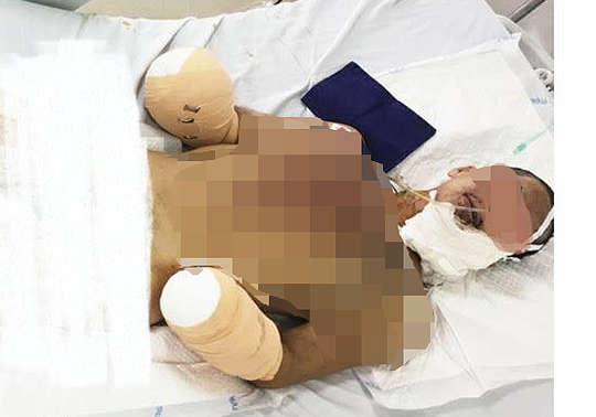 Nghi án nam thanh niên cụt 2 tay do sản xuất pháo: Công an Hải Phòng lên tiếng 