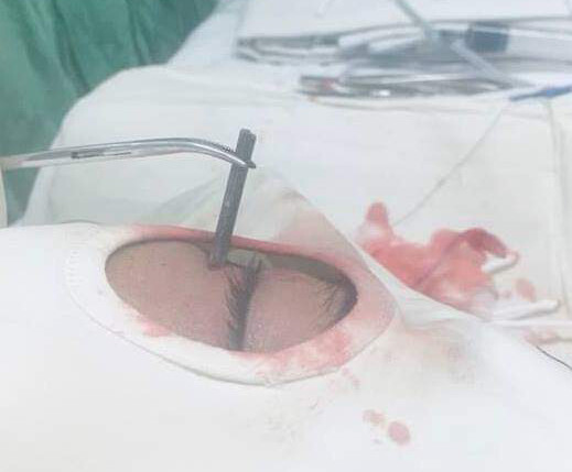 Tin tức đời sống mới nhất ngày 5/2/2019: Bị đinh bắn sâu vào hốc mắt lúc sửa nhà đón Tết