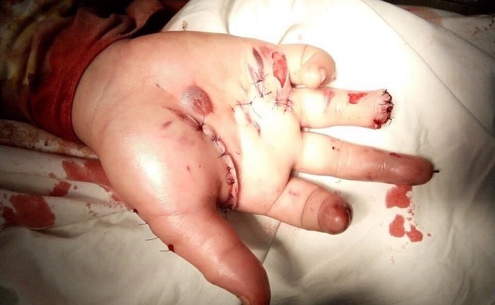 Tin tức đời sống mới nhất ngày 6/2/2019: Một học sinh bị nát bàn tay do đốt pháo tự chế