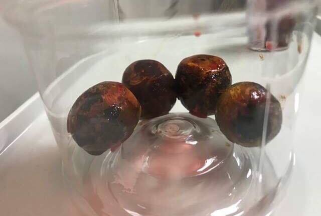 Tin tức đời sống mới nhất ngày 12/2/2019: Hốt hoảng phát hiện 4 viên sỏi to như quả mận trong túi mật