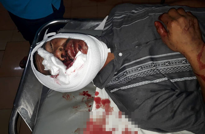 Hỗn chiến lúc bàn chuyện làm ăn, một người đàn ông bị đánh bằng tuýp sắt đến tử vong