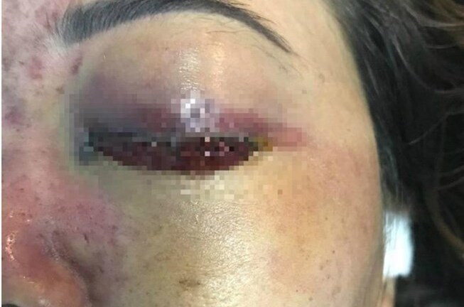 Cảnh báo tai biến khiến chị em mù mắt, hoại tử mũi khi làm đẹp