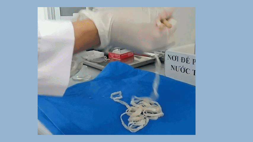 Kinh hãi cô gái thải ra sán lợn trưởng thành dài hơn 5 mét