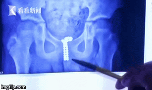 Bé trai 12 tuổi khốn khổ vì tự ý nhét 39 viên bi vào “cậu nhỏ” 