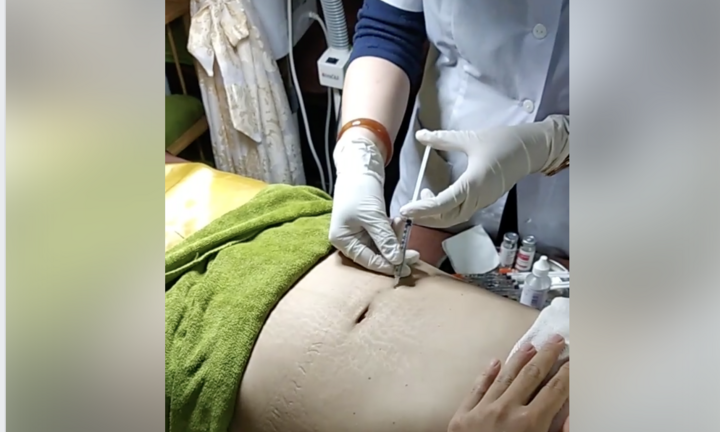Tiêm tinh chất tan mỡ: Cách làm đẹp tiềm ẩn đầy rủi ro