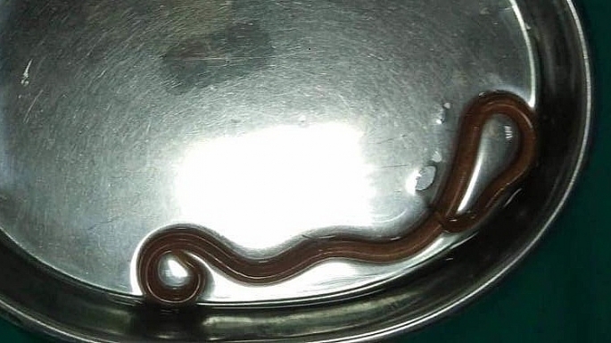 Rợn người xem bác sĩ “bắt” giun đũa dài 15cm ra khỏi cơ thể nữ bệnh nhân