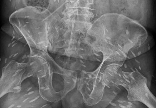 Thích ăn gỏi sống, cụ ông U80 biến cơ thể mình thành