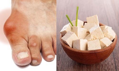 Người bị bệnh gút có ăn được đậu phụ không? 