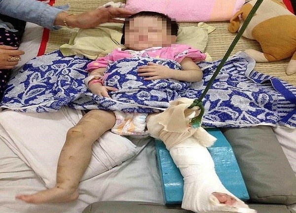 Khởi tố mẹ nuôi đánh gãy chân bé gái một tuổi vì không chịu ăn
