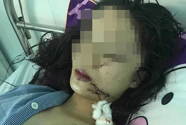 Tin tức thời sự 24h mới nhất ngày 22/4/2019: Thiếu nữ 18 tuổi xinh đẹp bị 3 cô gái dùng dao rạch mặt