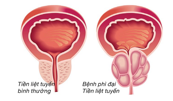 Tiền liệt vương – đẩy lùi phì đại tiền liệt tuyến với hiệu quả 93,3%