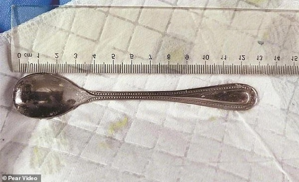 Vô tình để thìa rơi vào cổ họng, người phụ nữ chờ 4 ngày mới đi khám