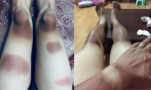 Dân mạng đua nhau khoe ảnh da cháy nắng mà không nghĩ tới hậu quả