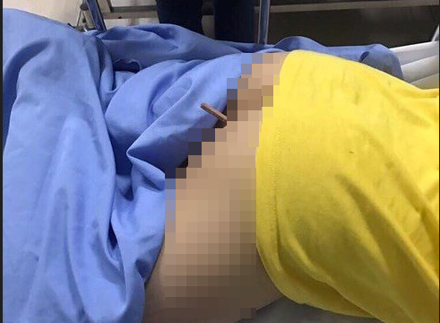 Bé trai 9 tuổi nhập viện cấp cứu vì bị bút chì đâm xuyên mông sau trò đùa của bạn học