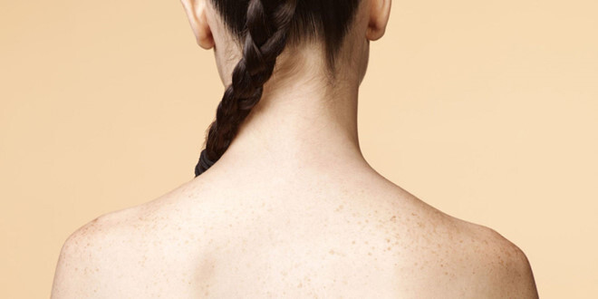 Mẹo trị sạch mụn lưng siêu đơn giản ngay tại nhà, không phải ai cũng biết