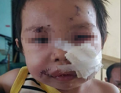 Sang nhà hàng xóm chơi, hai chị em bị chó cắn nhập viện cấp cứu